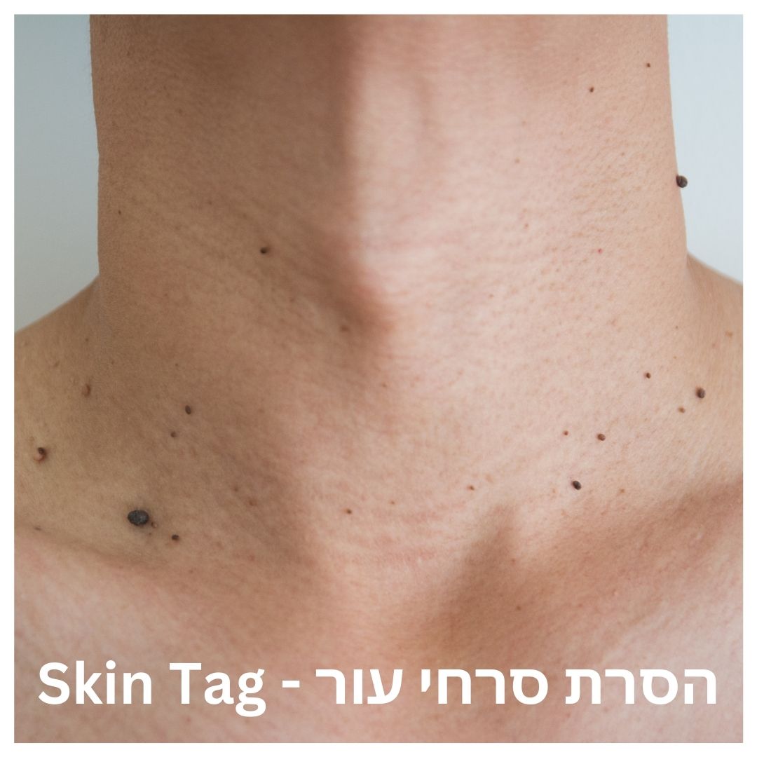 הסרת סרחי עור – skin tag
